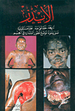 Aids: Its History - Facts About It - A Future Outlook