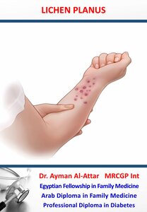 Lichen Planus