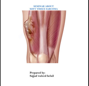 سرطان الأنسجة الرخوة/soft tissue sarcoma