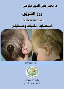 زرع الحلزون cochlear implant (استطبابه، تقنياته ومستقبله)