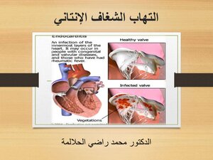 التهاب الشغاف الإنتاني