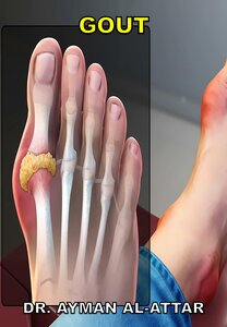 Gout