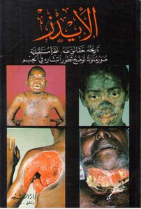 Aids: Its History - Facts About It - A Future Outlook